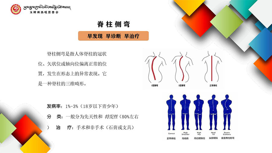 脊柱侧弯示意图